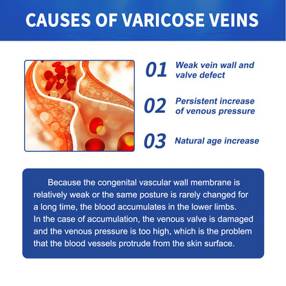 GDBadais Vein Massage Varicose Cream Repair Earthworm Legs To Relieve Leg Blood Vessel Bulge And Varicoidea